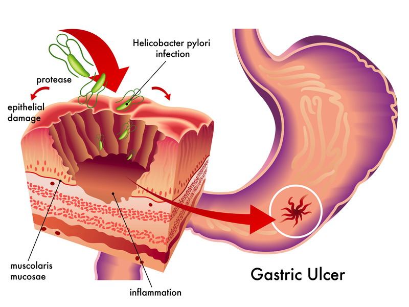 gastritis prikaz