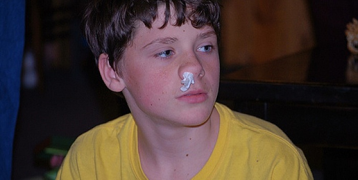 Krvarenje nosa kod djece: Znaš li kako ga pravilno zaustaviti?