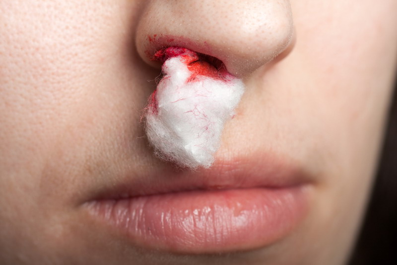 Krv iz nosa kod djece – zašto se javlja i kako je zaustaviti? | Zdravlje djece - Kreni zdravo!
